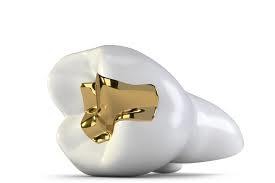 金歯　銀歯　歯医者さん【東広島店】